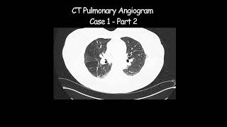 CT Pulmonary Angiogram  Case 1  Part 2 radiologist radiology angiogram pathological [upl. by Zeiler]