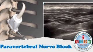 Paravertebral Nerve Block [upl. by Barri]