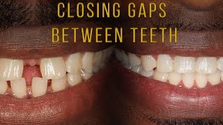 Closing Gaps Between Teeth With Braces [upl. by Quintus]