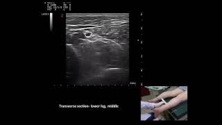 Ultrasound guided m tibialis posterior botulinum toxin injection by Murat Karkucak MD [upl. by Legim]