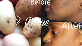 Removing Dark Spots in 7 Days 100 Natural  Acne Scars  Shellyposh Lifestyle [upl. by Eatnhoj974]