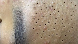 Big Cystic Acne Blackheads Extraction Blackheads amp Milia Whiteheads Removal Pimple Popping  388 [upl. by Ocimad]