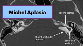 Michel Aplasia  Complete Labyrinthine Aplasia Radiology Radiology ENT Ear [upl. by Alyosha]