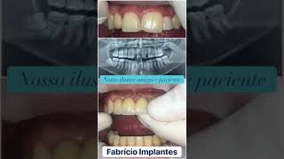 Antes e Depois  Dentes finalizamos pós implante [upl. by Milman]