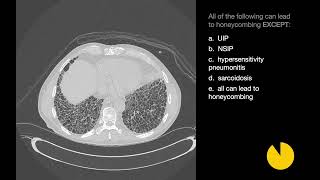 26 Cases of Interstitial Lung Disease  Xrays amp CT Scans [upl. by Enylhsa594]