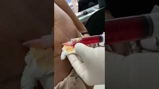 Seroma em abdominoplastia [upl. by Atilek767]