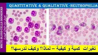 lecture 22 Neutrophilia Quantitative and Qualitative Changes [upl. by Ahtanoj]