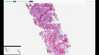 Benign osteogenic tumors  osteoid osteoma highyield educational video [upl. by Matthia]