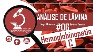 Análise de lâmina 06Hemoglobinopatia C [upl. by Fiske]