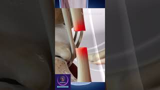 Achilles Tendon Surgery shorts education [upl. by Eerahc]