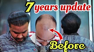 MY 7 YEAR HAIR TRANSPLANT RESULT UPDATE hair [upl. by Saito]