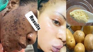 REMOVE DARK SPOTS PIGMENTATION DARK NECKSKIN BRIGHTENING MASKPOTATO FACE MASK [upl. by Sllew181]