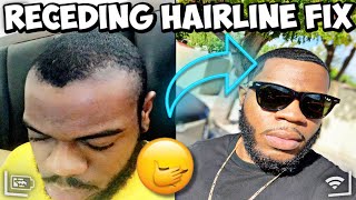 HOW TO FIX A RECEDING  THINNING HAIRLINE  IN 30 DAYS  😱😱🤯 [upl. by Pagas306]