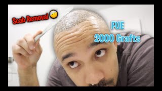 FUE HAIR TRANSPLANT 1 WEEK SCAB REMOVAL [upl. by Nyahs]