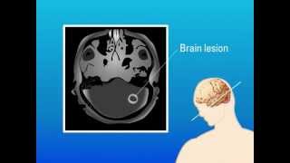 Extrapulmonary Aspergillosis – Type of Fungal Infection [upl. by Fuchs915]