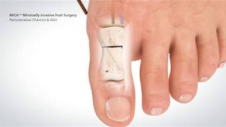 Percutaneous Forefoot Surgery  Dr Tim OCarrigan [upl. by Nawuj]