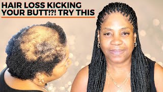 HOW TO BOX BRAID FOR BEGINNERS ALOPECIA VERSION [upl. by Ariat]