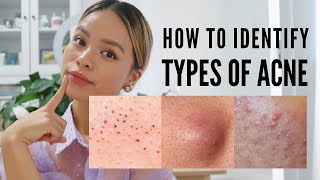 How to treat EVERY type of acne With Pictures [upl. by Neeloj]