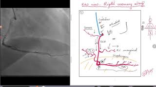 Coronary Angiogram RAO view for Right Coronary Artery [upl. by Ellimaj]