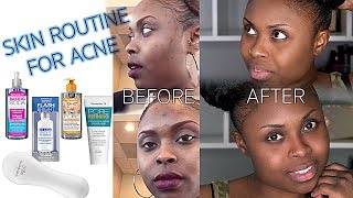 SKIN ROUTINE FOR ACNE USING DERMACTIN TS  HOW TO GET CLEAR SKIN  MAKEUP BY CARRIE [upl. by Hairaza]