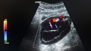 ultrasound case  Small bowel lymphoma [upl. by Icat]