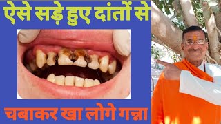 ऐसे सड़े हुए दांतों से चबाकर खा लोगे गन्ना how to get rid of cavity without going to the dentist [upl. by Tihw690]