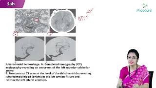 Subarachnoid Hemorrhage Hindi  Internal medicine [upl. by Aticnemrac856]