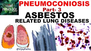 PNEUMOCONIOSIS Part 3 ASBESTOS related lung diseases [upl. by Ayat127]