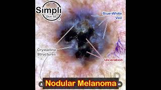 Nodular Melanoma Dermoscopy [upl. by Acissey]