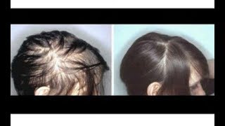 MENAKJUBKAN Inilah Cara Menebalkan Rambut Rontok [upl. by Leoy89]