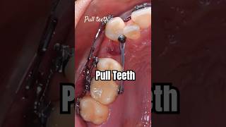 How to pull teeth when braces braces orthodontist dentist dental [upl. by Grimbald]