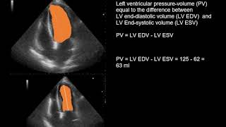 Echocardiography in the patient with acute anteroseptal myocardial infarction [upl. by Laird592]