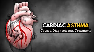 Cardiac Asthma Causes Signs and Symptoms Diagnosis and Treatment [upl. by Erialcyram]