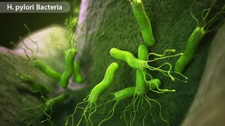 Hpylori  Causes and Symptoms  Treatment Allopathic  Helicobacter infection treatment [upl. by Ayotahc]