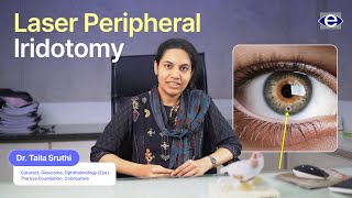 Laser Peripheral Iridotomy  Common Eye Conditions  The Eye Foundation eyecare eyecareservices [upl. by Enelegna]