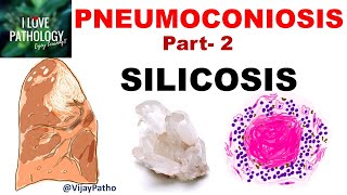 PNEUMOCONIOSIS Part 2 Silicosis pathogenesis morphology  clinical features amp complications [upl. by Ahso]