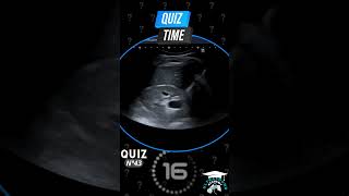 Ultrasound Quiz Challenge  43 Can You Diagnose This Case ultrasoundscans ultrasoundcases [upl. by Alie]