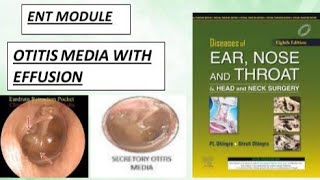 ENT OTITIS MEDIA WITH EFFUSION ear effusion ent dhingra [upl. by Princess]