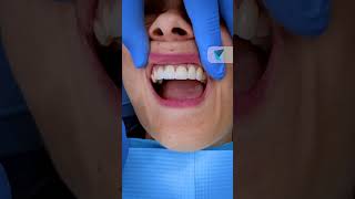 Prueba de Carillas Dentales Solución Rápida y Efectiva en Tu Sonrisa saluddental carillasdentales [upl. by Tryck]