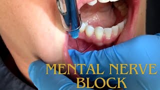 Mental Nerve Block شرح  Local Anaesthesia for Mental Nerve [upl. by Ashly]