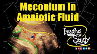 Meconium in Amniotic Fluid  Ultrasound  Case 314 [upl. by Bernhard22]