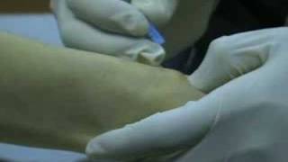 Ganglion Cyst Removal with Acupuncture [upl. by Ahsitram]