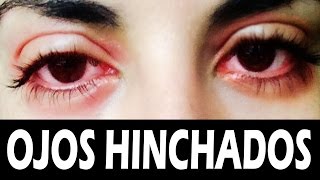 Remedios caseros para los ojos hinchados [upl. by Ttennej]