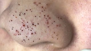 Big Cystic Acne Blackheads Extraction Blackheads amp Milia Whiteheads Removal Pimple Popping  8996 [upl. by Inalawi]