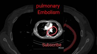 Pulmonary Embolism shorts radiology [upl. by Jeunesse130]