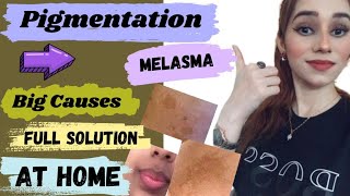 How to get rid of pigmentation melasma at home Pigmentation cream Pigmentation causes Treatment [upl. by Airda]