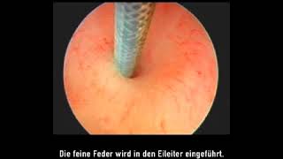 Die Sterilisation bei der Frau Essure Methode [upl. by Corliss]