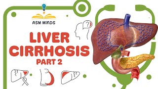 Liver cirrhosis part 2 [upl. by Clareta]