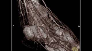 Vascular CT angiography of the lower extremity3 of 3 [upl. by Elodie386]