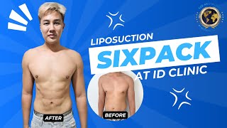 LIPOSUCTION for SIXPACK at ID CLINIC BANGKOK THAILAND [upl. by Zaslow]